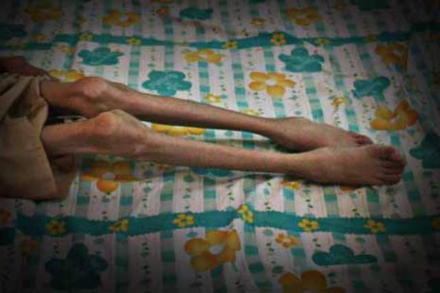 Seminggu Dirawat, Bocah Penderita Gizi Buruk di SBT Meninggal